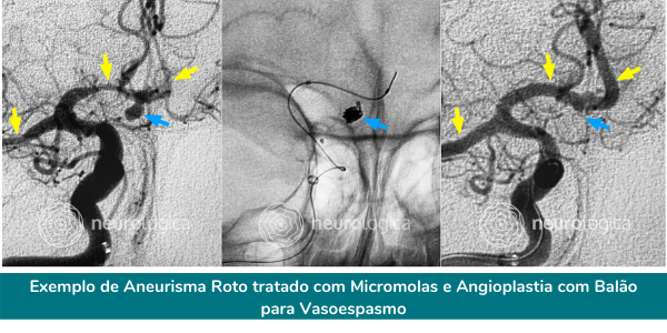 aneurisma roto tratado micromolas e angioplastia com balão para vasoespasmo