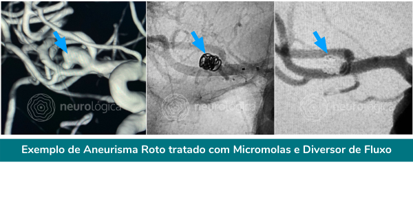 aneurisma roto tratado micromolas diversor de fluxo