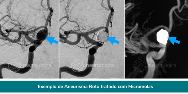 aneurisma roto tratado micromolas 