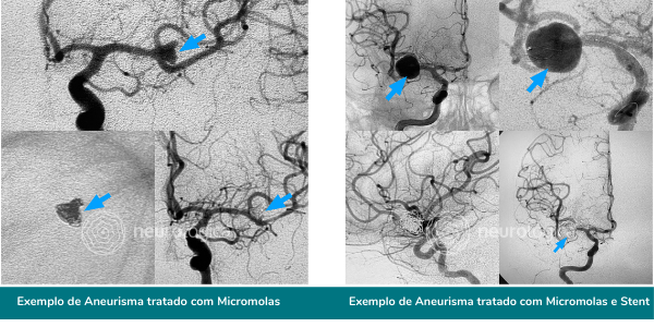 aneurisma tratado micromolas stent neurologica